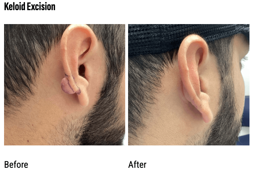 Keloid Excision